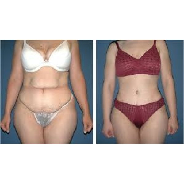 Clínica de Abdominoplastia no Centro