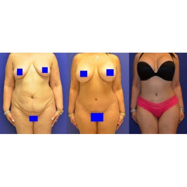 Clínica de Abdominoplastia no Tatuapé