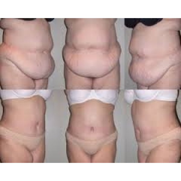 Clínica de Abdominoplastia