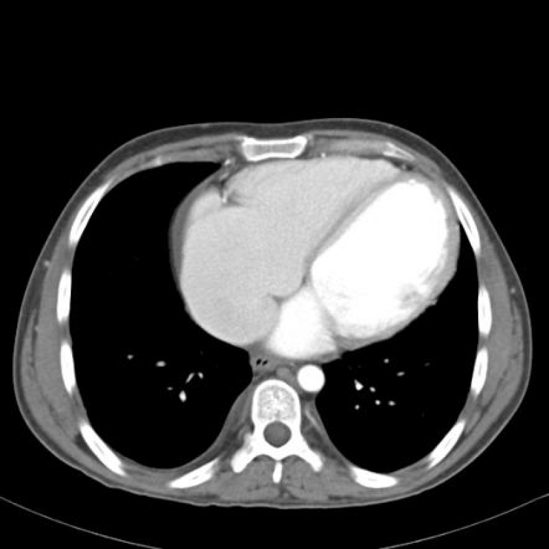 Clínica de Cardiologia para Tratar Miocardites