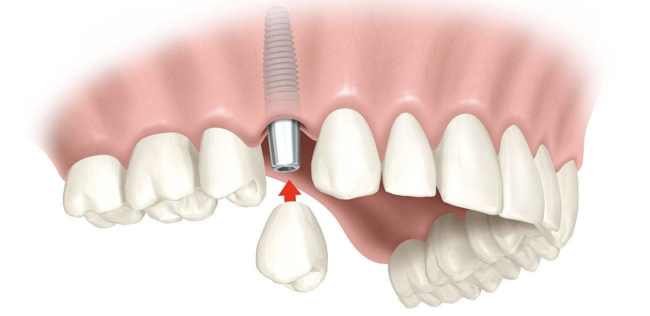 Clínica de Implante Dentário