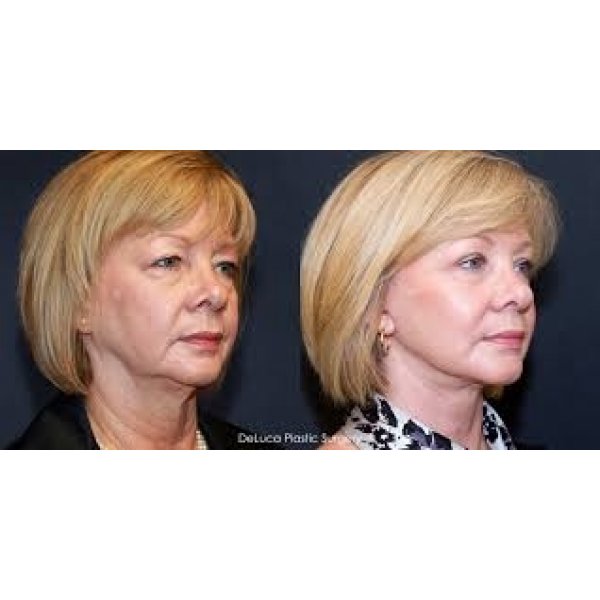 Clínica de Lifting Facial