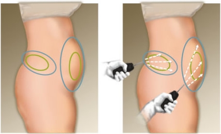 Clínica de Lipoaspiração em Curitiba