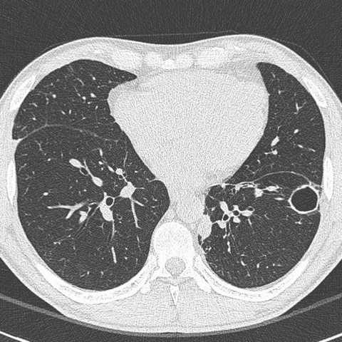 Clínica de Pneumologia para Bronquite