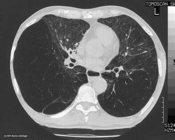 Clínica de Pneumologia para Tratar Apneia