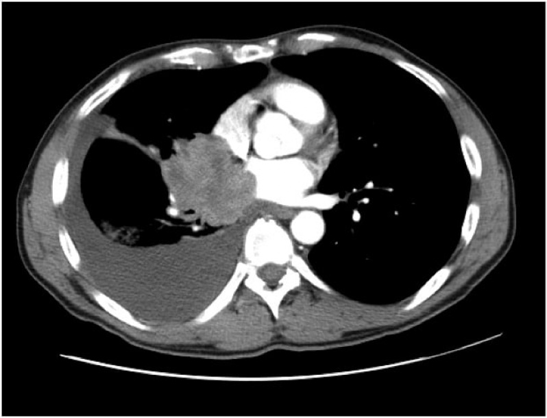 Clínica de Pneumologista para Tosse Seca