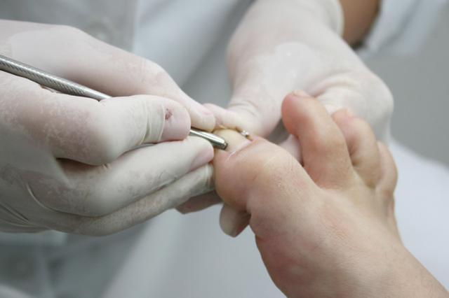 Clínica de Reconstrução de Unhas de Pés