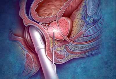 Clínica de Urologia para Tratamento Câncer