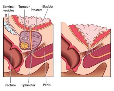 Clínica de Urologia para Tratar Câncer de Rim