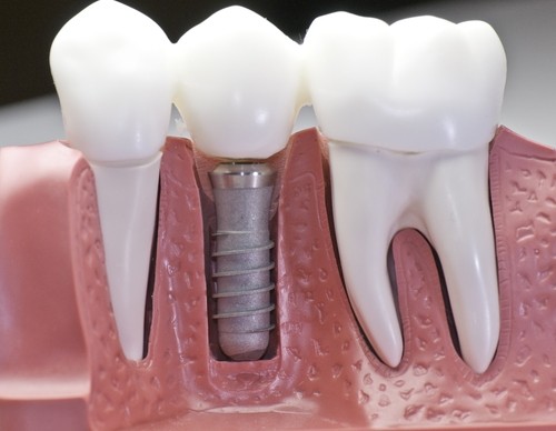 Clínica Odontológica de Implante Dentário