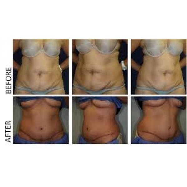 Clínica para Abdominoplastia