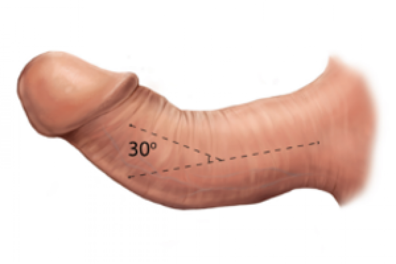 Clínica para Cirurgia de Revascularização Peniana