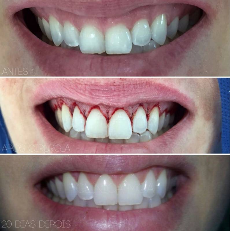 Clínica para Clareamento Dental a Laser