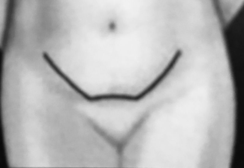 Clínica para Dermolipectomia Abdominal