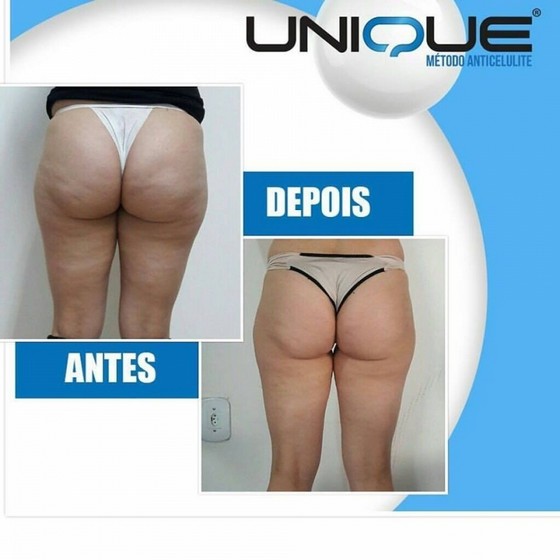 Clínica para Tirar Gordura Localizada Culote