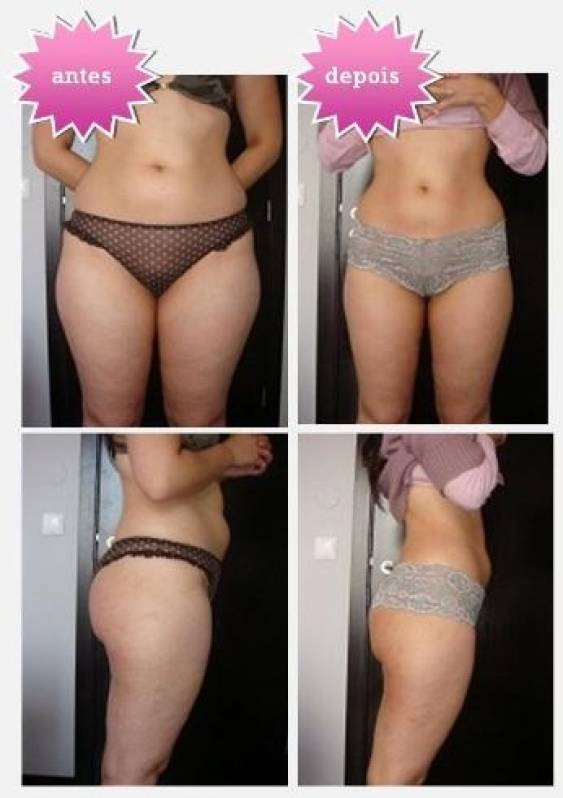 Clínica para Tratamento de Lipocavitação