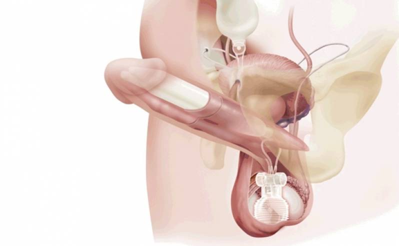 Clínica Particular para Engrossar Pênis