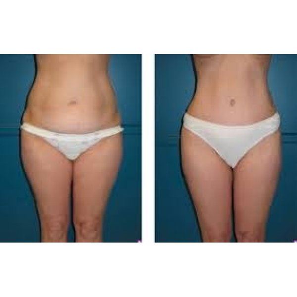 Clínicas de Abdominoplastia