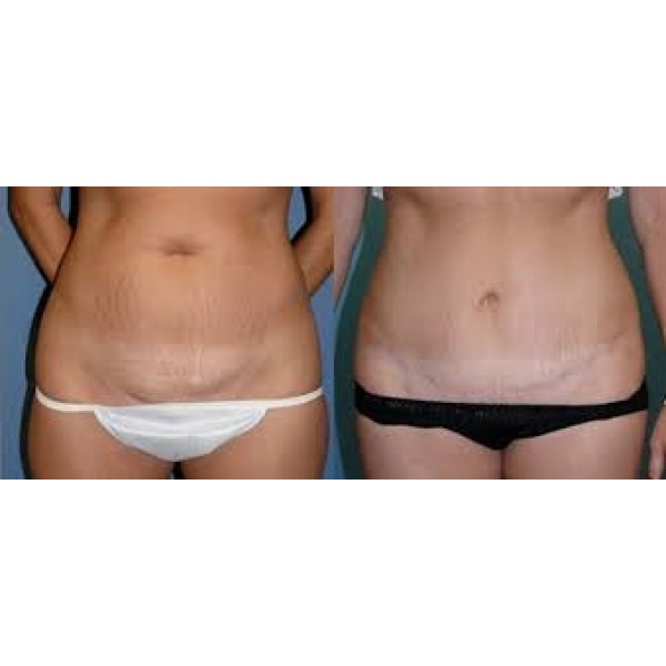 Clínicas de Cirurgias Plásticas de Abdominoplastia