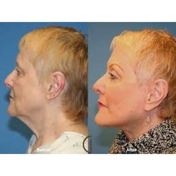 Clínicas Lifting Facial