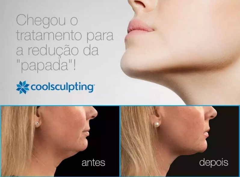 Coolsculpting para Emagrecer