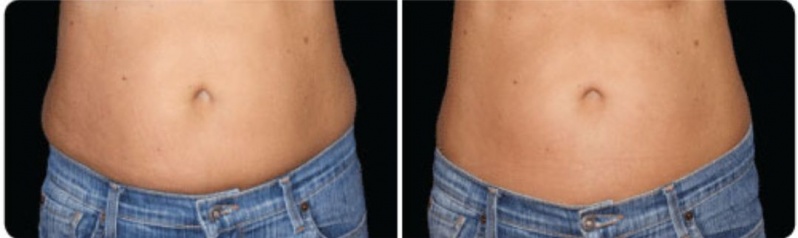 Coolsculpting para Gordura