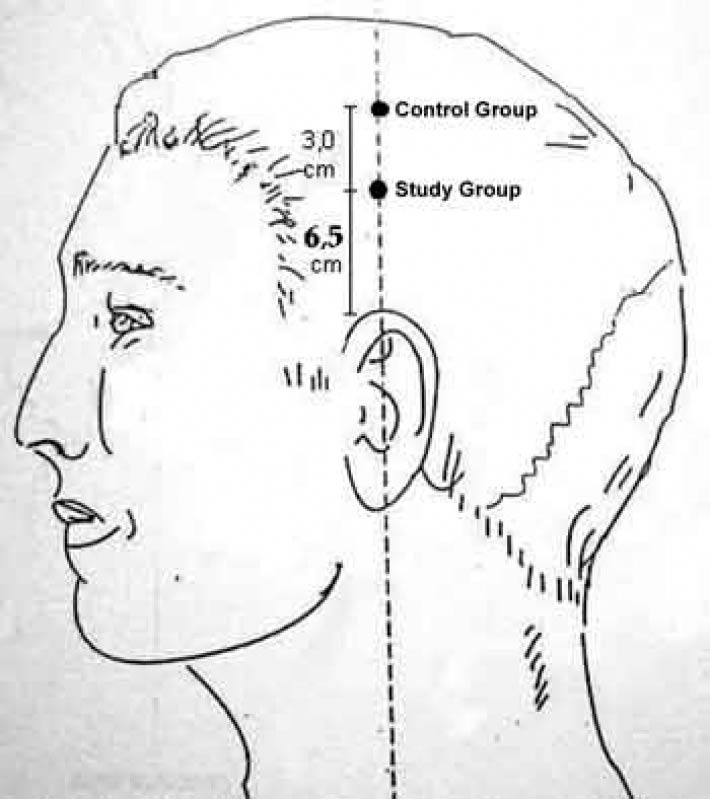 Craniopuntura para Dor de Cabeça Frontal