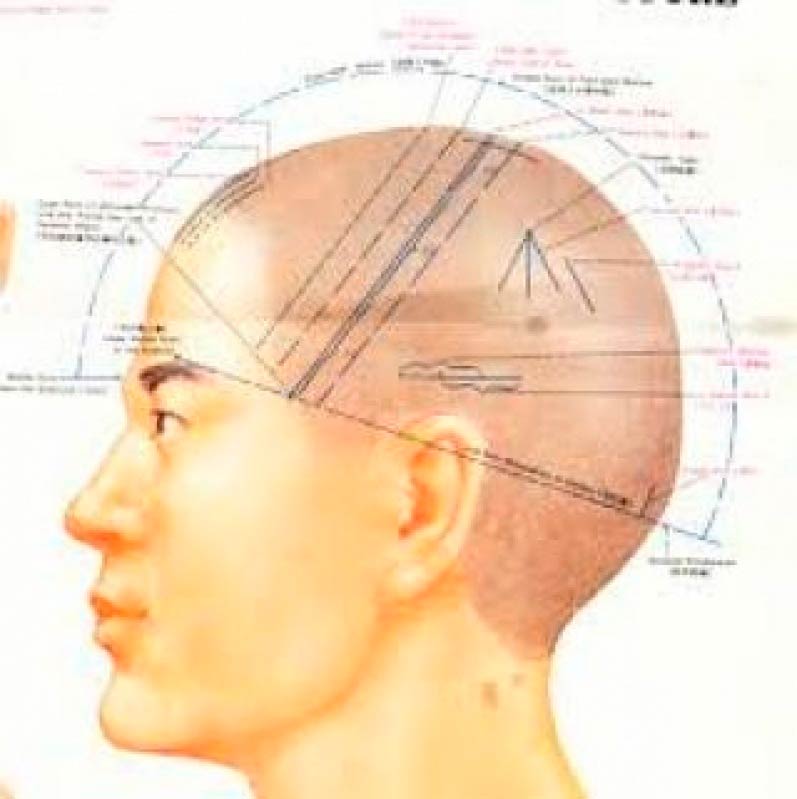 Craniopuntura para Dor de Cabeça Tensional