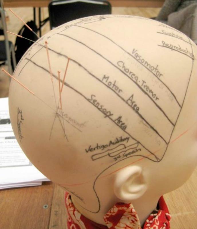 Craniopuntura para Enxaqueca