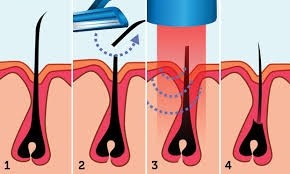 Depilação a Laser Masculina