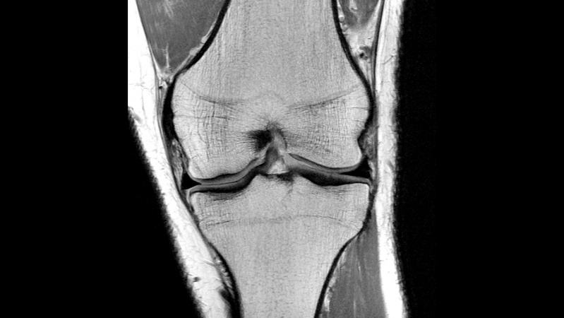 Exame de Ressonância em Joelho Esquerdo