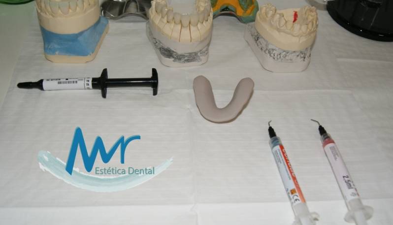 Faceta Dental em Porcelana