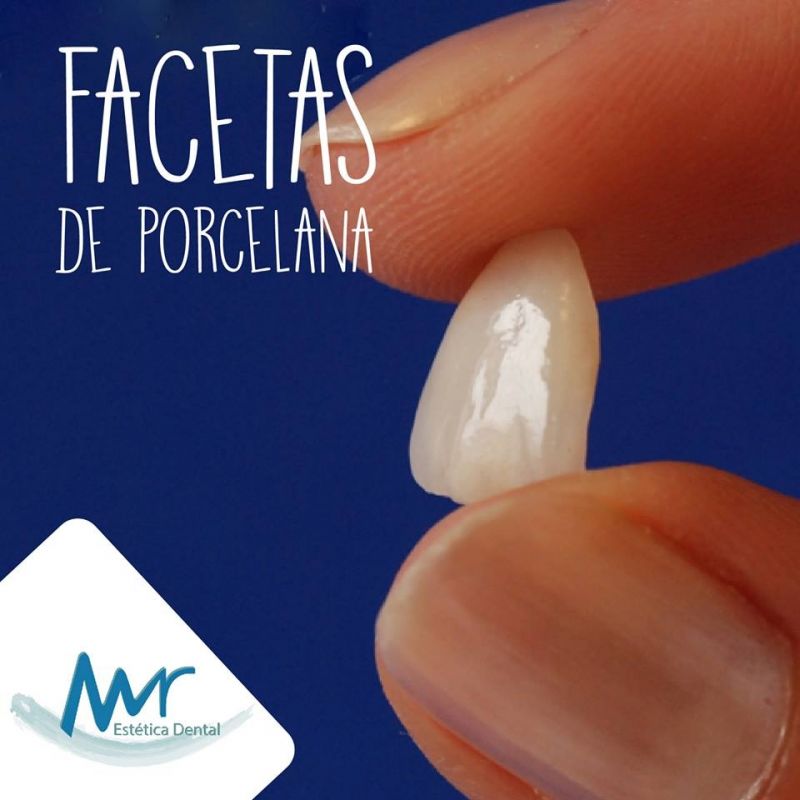 Faceta Dental em São Paulo