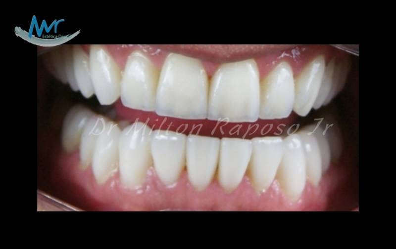 Facetas Dentárias para Dentes Tortos