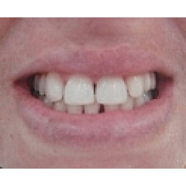 Fechamento de Diastema com Resina