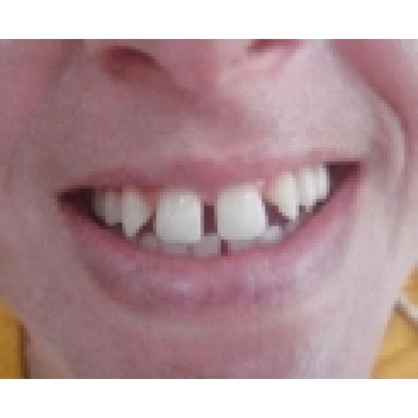 Fechamentos de Diastema