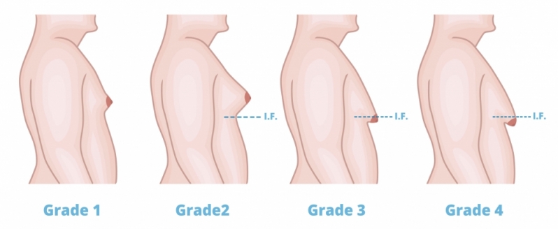 Ginecomastia Grau 1