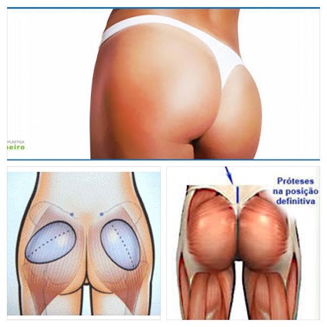 Gluteoplastia de Aumento