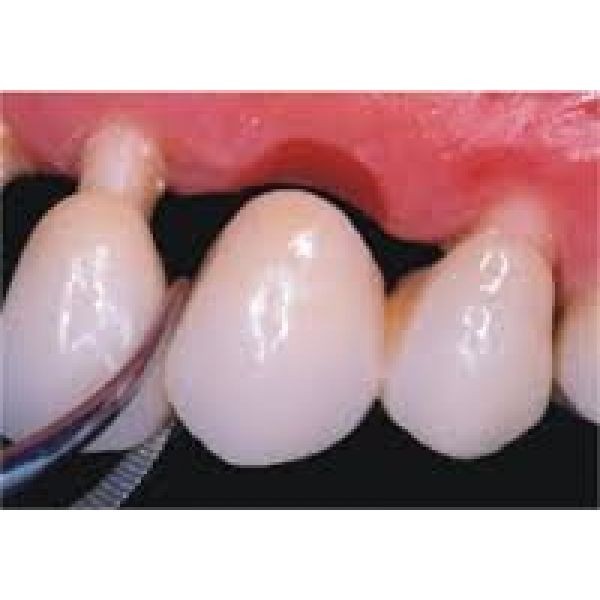 Implante de Dente