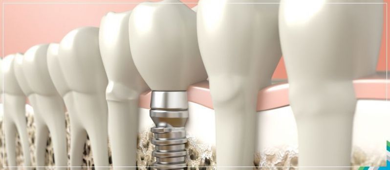 Implante de Dentes Superiores