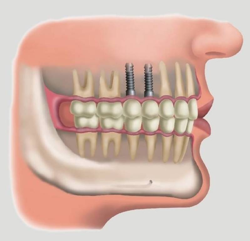 Implante Dentário