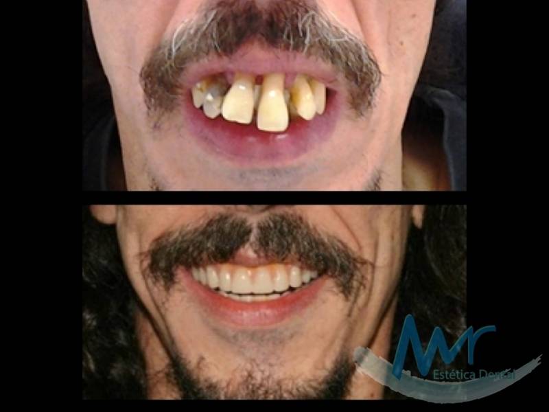 Implante Dentário com Enxerto