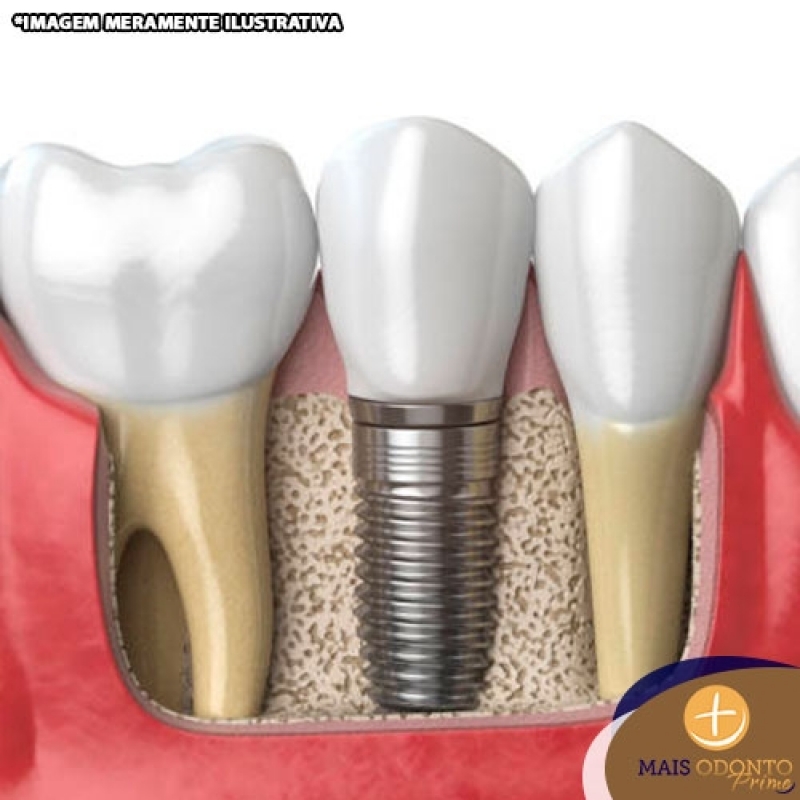 Implante Dentário de Carga Imediata