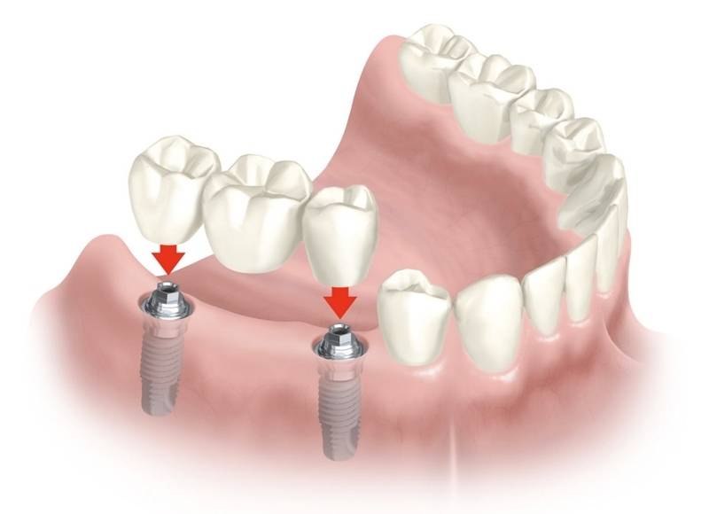 Implante Dentário de um Dente