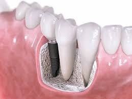 Implante Dentário em Taboão da Serra