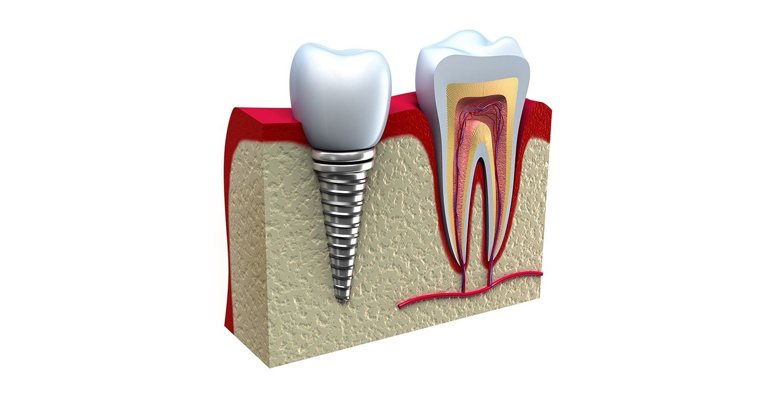 Implantes de Dentes