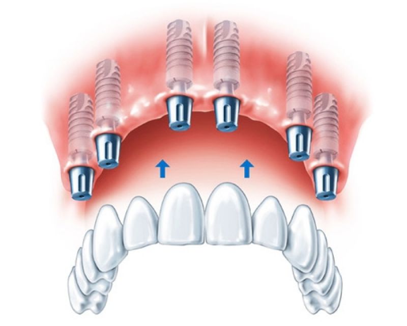 Implantes Dentários em São Paulo