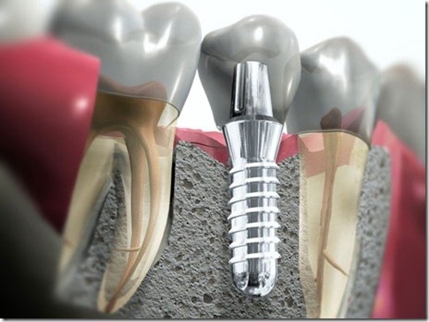 Implantes Dentários em Sp