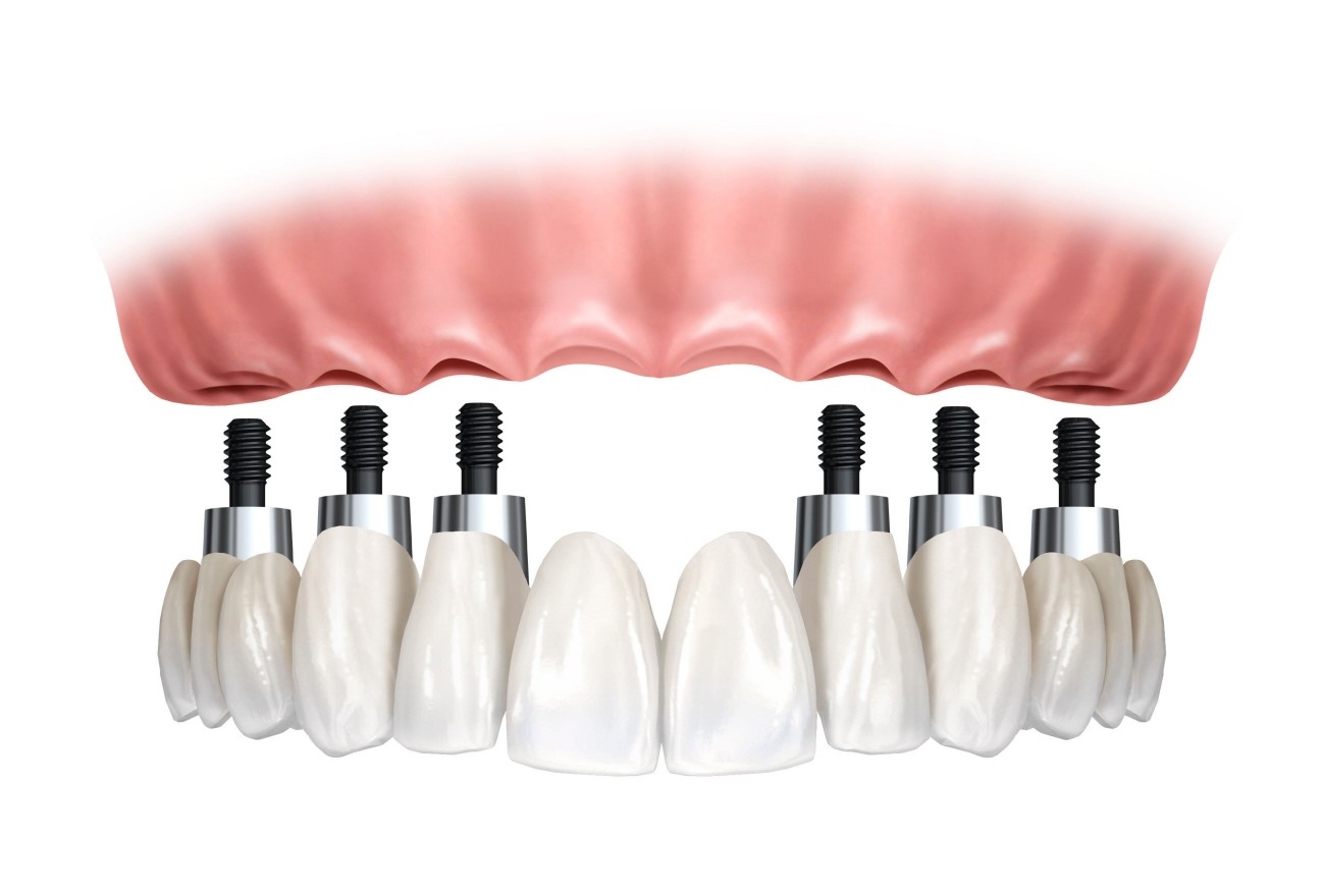 Implantes Dentários