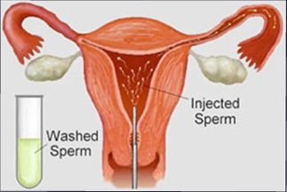 Inseminação Artificial Humana